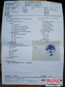 江苏女子做两癌筛查4个月后才被告知患癌 官方：工作有瑕疵