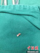 男童呛入鱼骨呼吸衰竭 多学科医生协作开胸取出